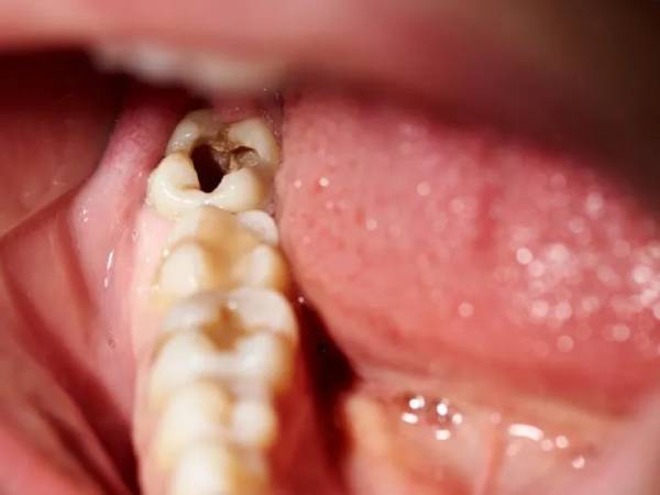 Chiêm bao thấy người thân bị sâu răng